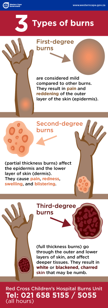 2nd degree burns blisters